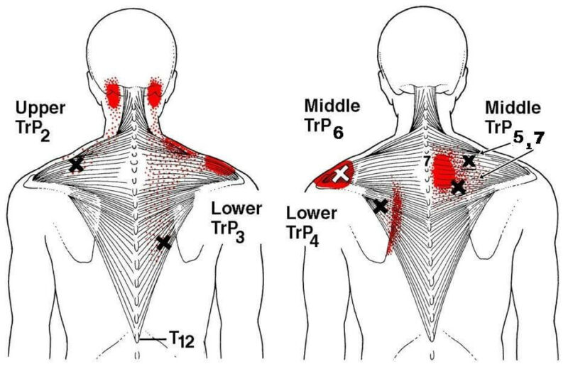 Trigger point | La Guida completa - Mdm Fisioterapia