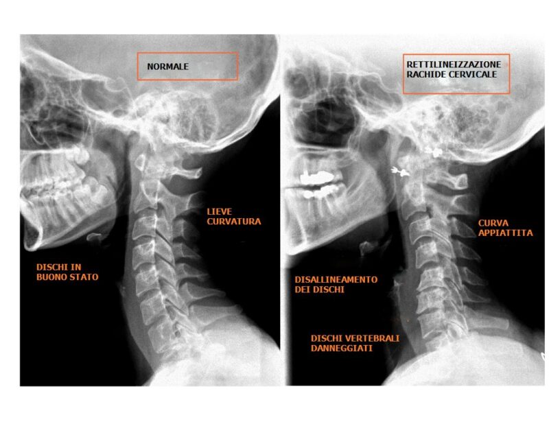 Sintomi Cervicale | La Guida Completa - Mdm Fisioterapia