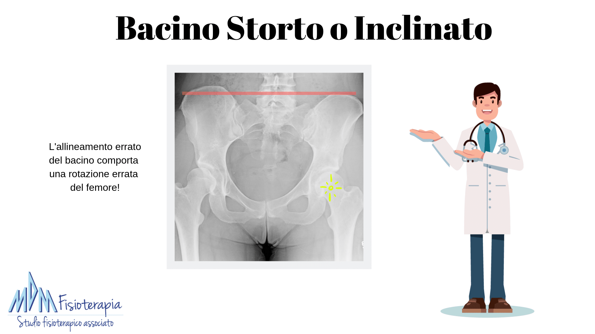 Bacino Ruotato Può Dare Problemi Neurologici